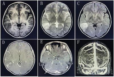 Case report: Coexistence of Labbe vein thrombosis and autoimmune encephalitis with two different antibodies